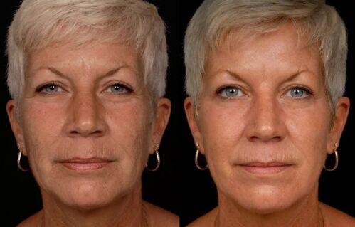 The result of laser facial skin treatment - wrinkle reduction