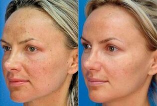 photos before and after skin rejuvenation with the device